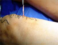 Imagem: cirurgia de varizes