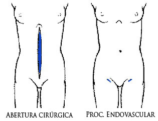 Imagem (Cirurgia endovascular abertura cirúrgica e procedimento endovascular)