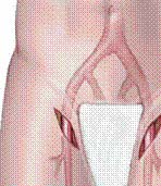 Imagem (Cirurgia endovascular abertura cirúrgica e procedimento endovascular)