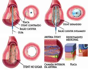 Imagem (Cirurgia endovascular, stent/artérias)
