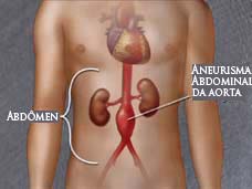 Imagem (Aneurisma abdominal da aorta)
