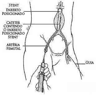 Imagem (Aneurisma)