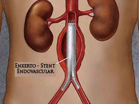 Imagem (Aneurisma)