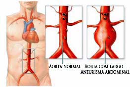 Imagem (Aorta, com largo aneurisma abdominal)