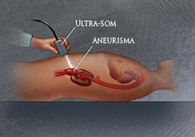 Imagem (Ultra-som - Aneurisma)