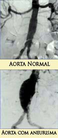 Imagem (Aorta normal e aorta com aneurisma)