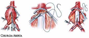 Imagem (Aneurisma - Cirurgia aberta)