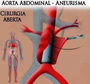 Imagem (Aorta abdominal - Aneurisma - Cirurgia aberta)