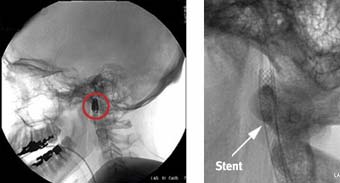 Imagem (Stent)