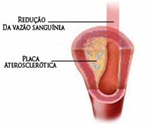 Imagem (AVC)