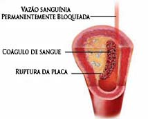 Imagem (AVC)