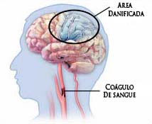 Imagem (AVC)