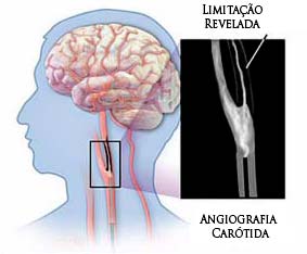 Imagem (exame diagnóstico de AVC - angiografia carótida)