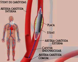 Imagem (Stent. de carótidas)