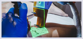 Tratamento de varizes a laser