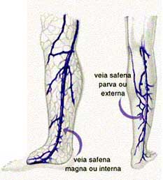 Imagem varizes