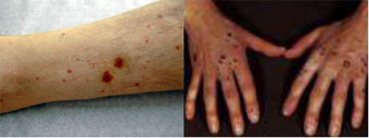 Imagem - (vasculite)