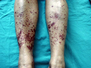 Imagem - (vasculite)