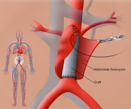 Imagem: Procedimentos arteriais - tratamento cirúrgico de aneurisma de aorta abdominal