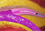 Imagem: Procedimentos venosos - cirurgia de varizes a laser endovenoso