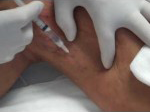 Imagem: Procedimentos venosos - escleroterapia (aplicação de vasinhos)