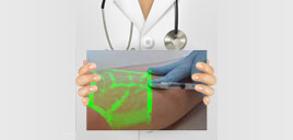 Escleroterapia com espuma