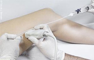 Imagem (Escleroterapia com espuma ecoguiada 2)